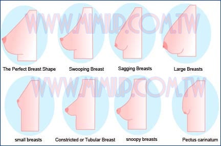 隆乳胸型分類