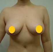 垂直切口縮乳手術 