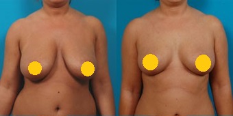 垂直切口縮乳手術 