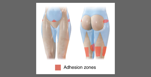 腿部抽脂,紅色部位是黏著區, 在大腿抽脂屬於不能抽脂的部位