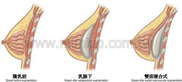 隆乳-義乳放置位置