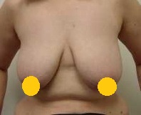 垂直切口縮乳手術 