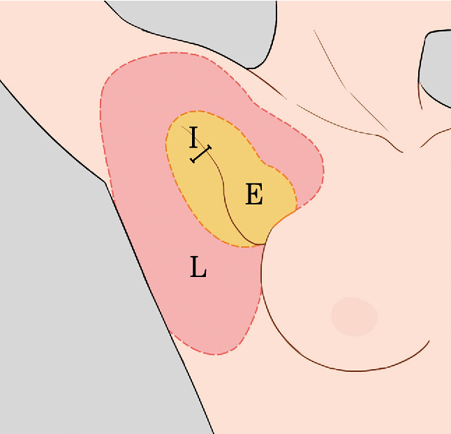 除狐臭手術與副乳抽脂可同時進行