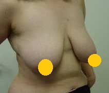垂直切口縮乳手術 