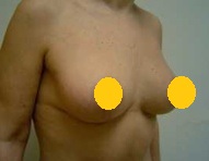垂直切口縮乳手術 