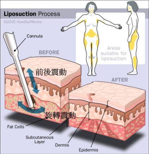 動力輔助抽脂原理