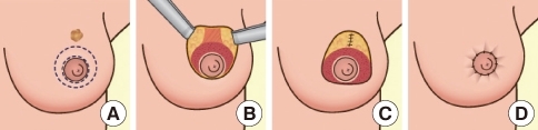 乳暈旁切口縮乳 