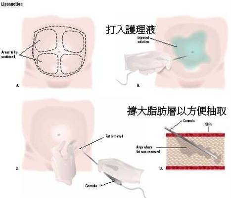 純手工抽脂