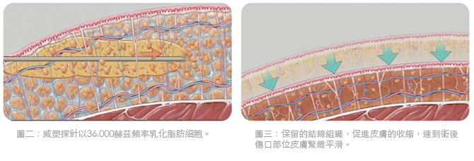 3D威塑抽脂 - 抽取深層與淺層皮下脂肪, 雕刻身材曲線效果好