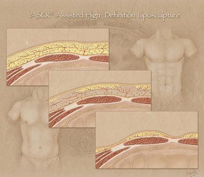 4D 威塑脂雕, 4D VASER Lipo 