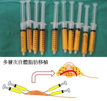 自體脂肪隆乳