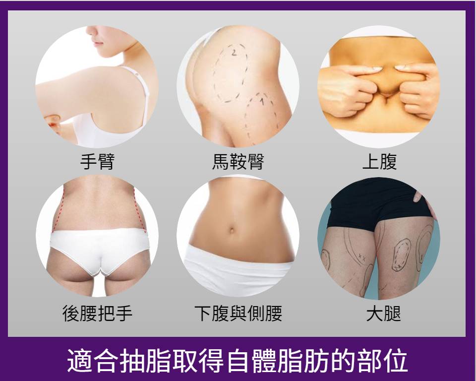 適合自體脂肪隆乳的抽脂部位