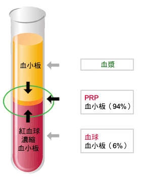 PRP, 豐富血小板生長因子