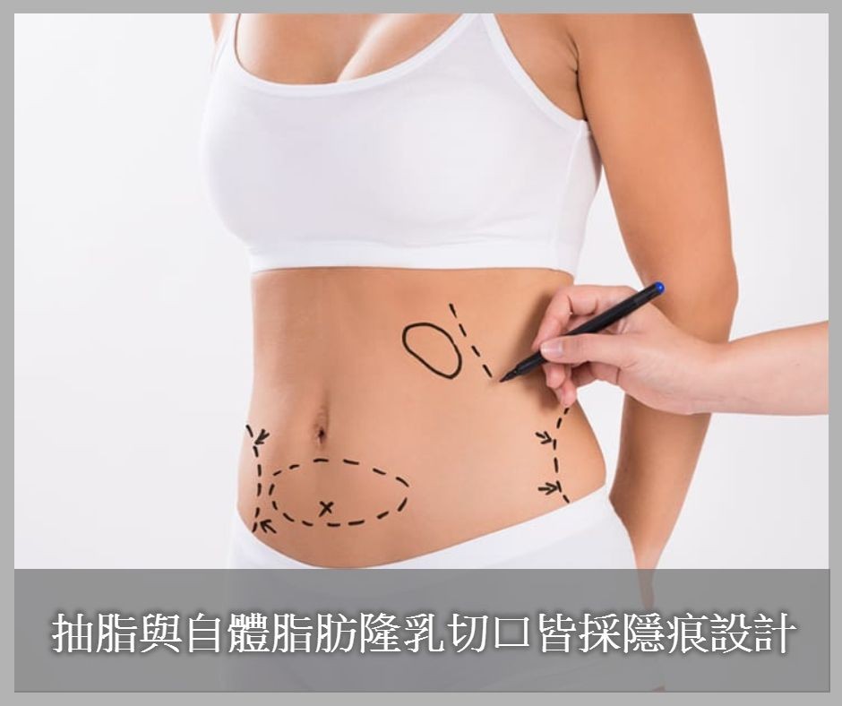 自體脂肪隆乳的手術切口位置