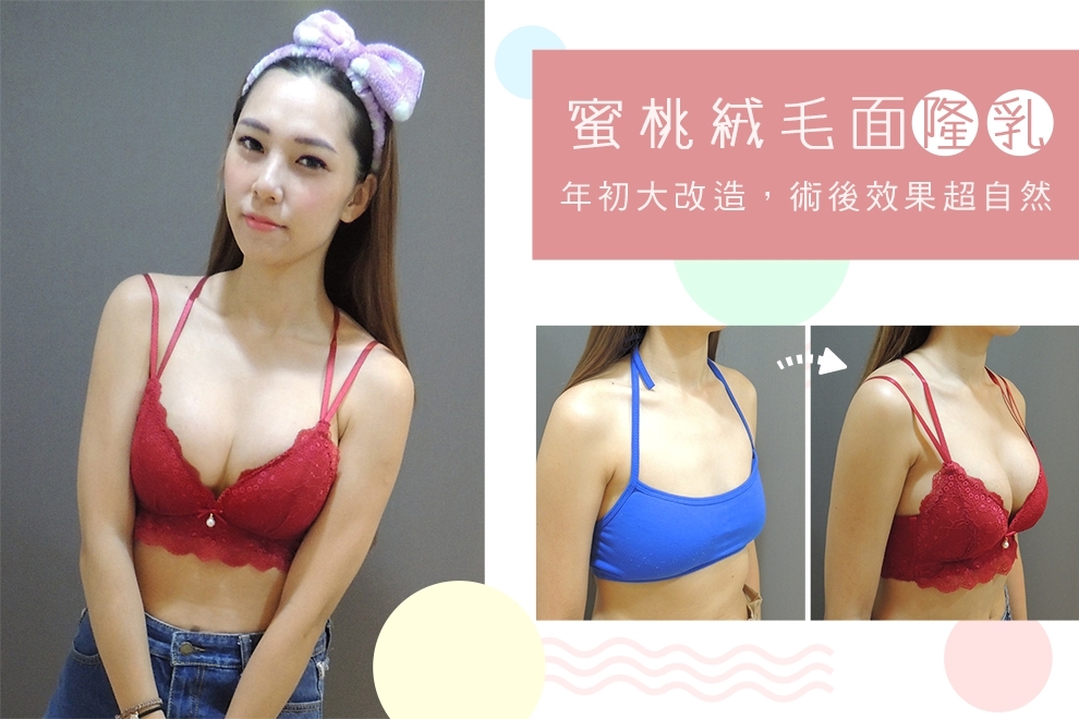 二代雙面複合式隆乳