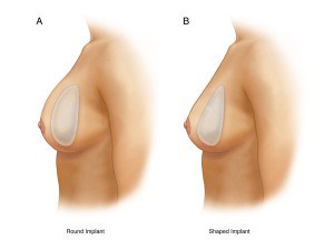 水滴形果凍矽膠隆乳 vs 圓盤形果凍矽膠隆乳