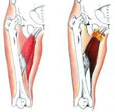 骨盆與大腿骨的位置決定馬鞍部所能縮小的最大極限