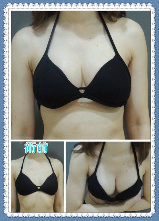 內視鏡隆乳