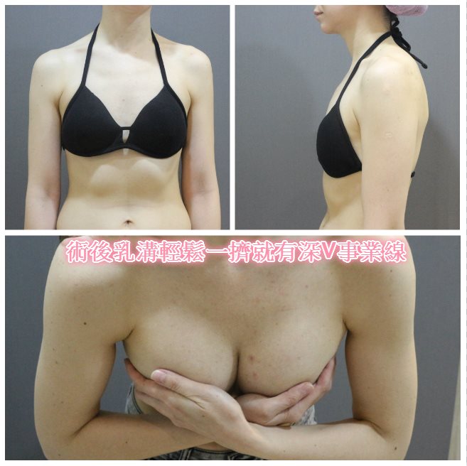 蜜桃絨隆乳