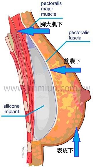 自體脂肪隆乳 - 多點多層次注射