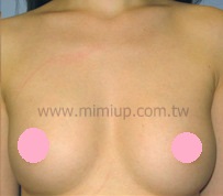 筋膜下蜜桃絨隆乳 - 自然動人的乳溝