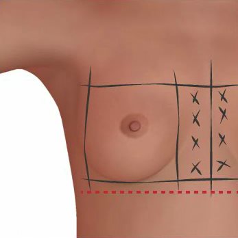 內視鏡腋下隆乳 - 雙側乳房距離胸中線各2公分處是不建議處理的地方