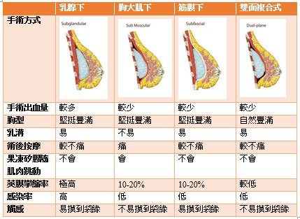 隆乳位置評比 - 雙面複合式(Dual Plane)