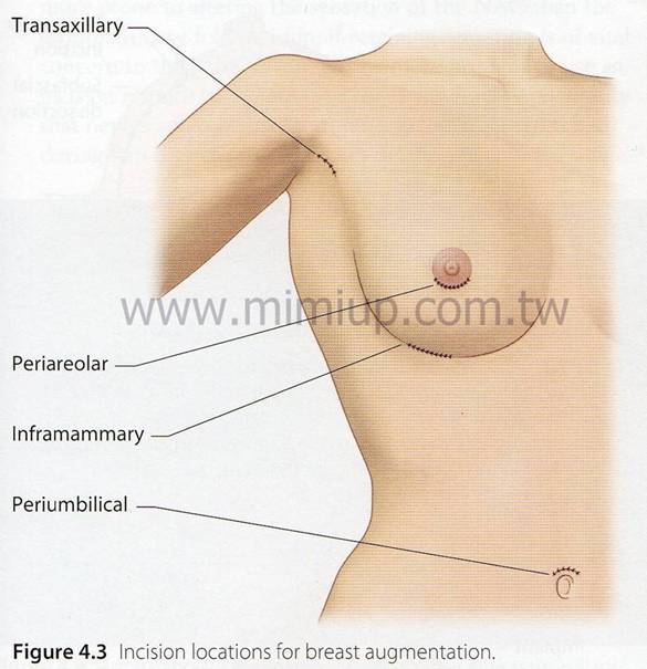 隆乳手術切口