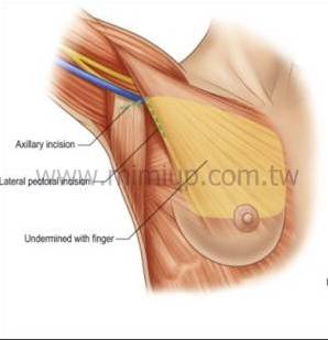 腋下隆乳