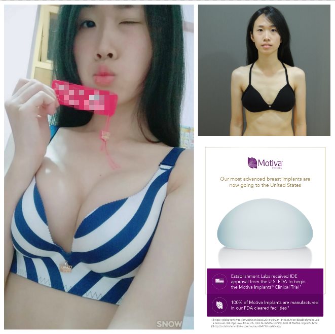 雙面複合式隆乳