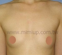 果凍矽膠隆乳術前
