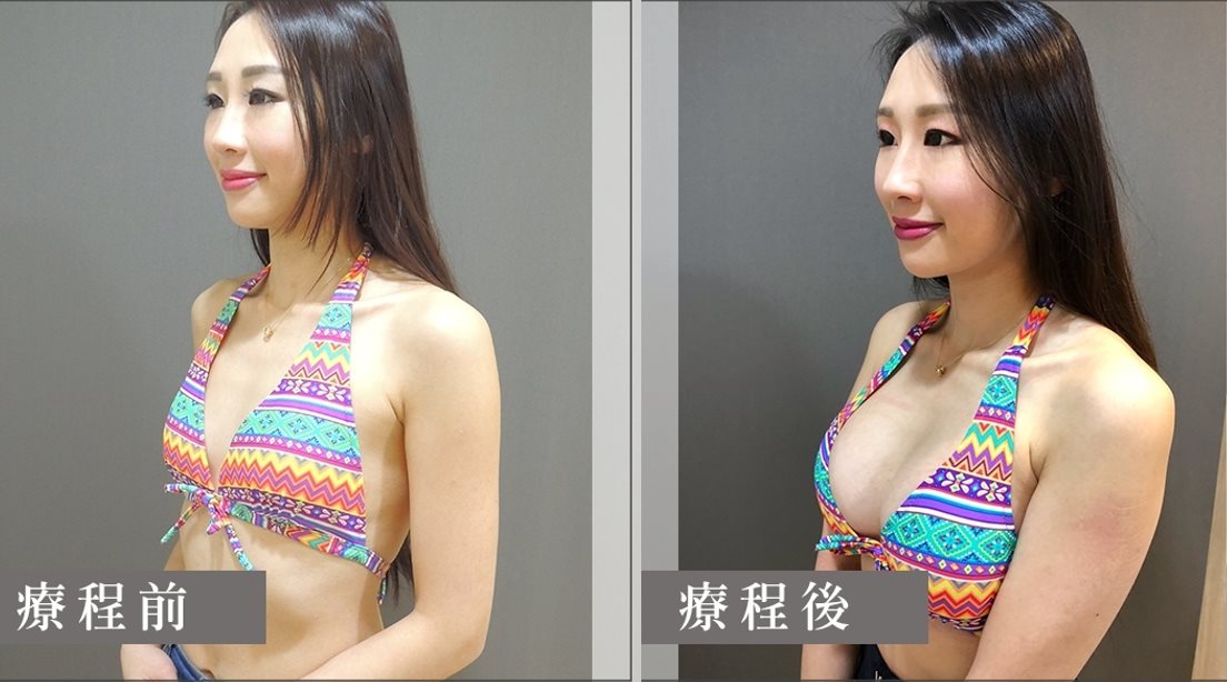 雙面蜜桃隆乳