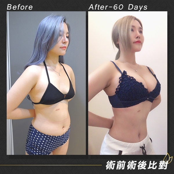 腹部抽脂, 威塑抽脂, 自體脂肪隆乳