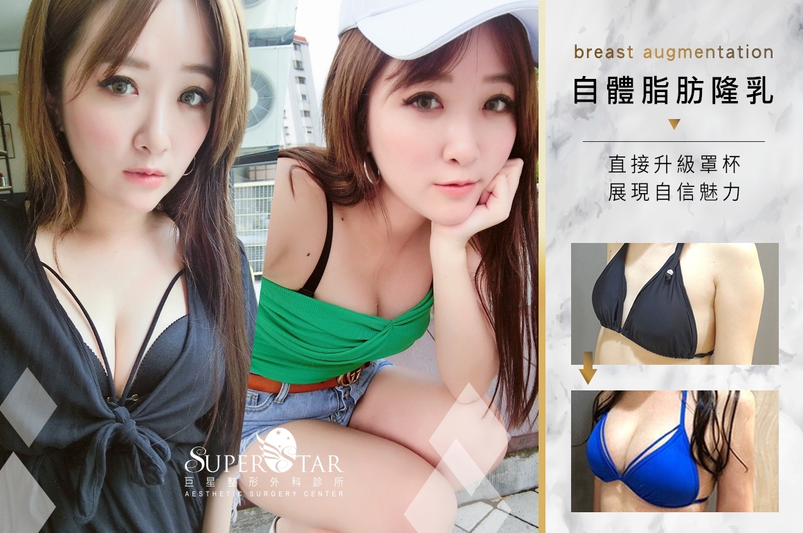 自體脂肪隆乳, 自體脂肪丰胸