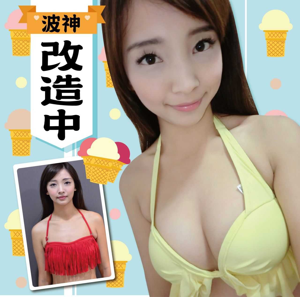 自體脂肪隆乳