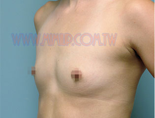 扁平胸型,圓盤形 - 荷包蛋奶 扁平胸型,圓盤形 - 荷包蛋奶