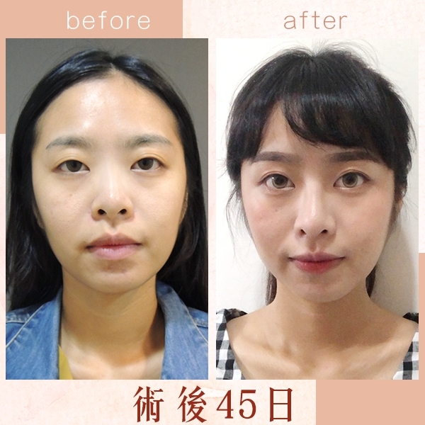 三段式隆鼻 三段式隆鼻