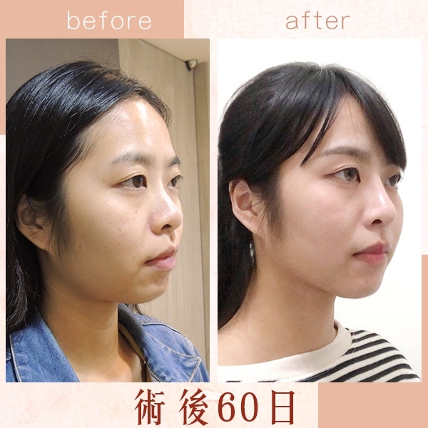 三段式隆鼻 三段式隆鼻