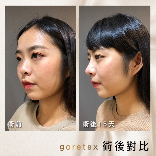 三段式隆鼻 三段式隆鼻