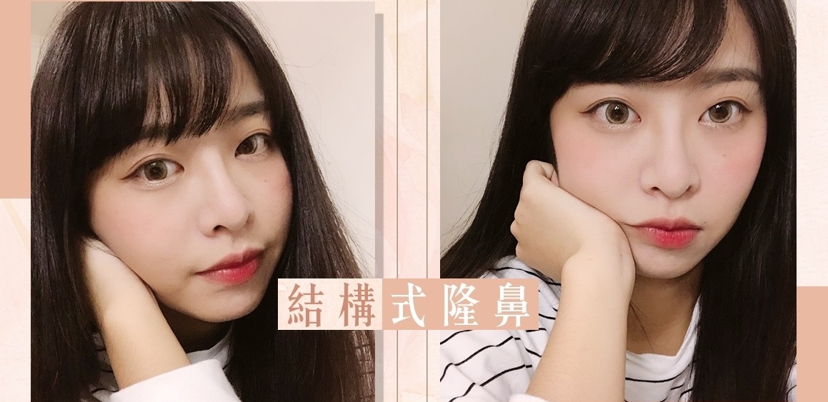 Goretex, 隆鼻, Pure form Goretex, 隆鼻, Pure form