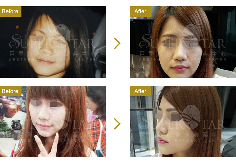 二段式隆鼻, 結構式隆鼻 二段式隆鼻, 結構式隆鼻