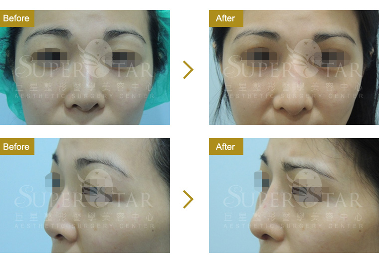 隆鼻重修, 隆鼻修復 隆鼻重修, 隆鼻修復