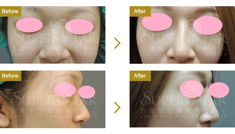 二段式韓式隆鼻 – 人工骨韓式隆鼻 二段式韓式隆鼻 – 人工骨韓式隆鼻