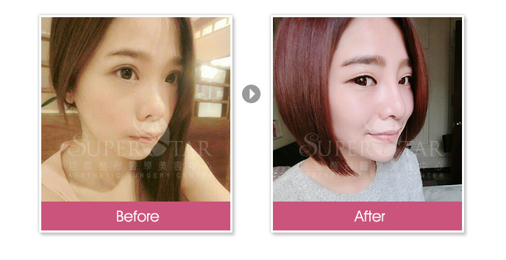 韓式隆鼻, 三段式隆鼻 韓式隆鼻, 三段式隆鼻