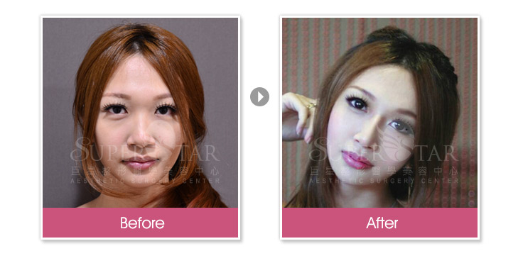 二段式隆鼻 二段式隆鼻