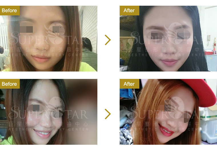 三段式隆鼻 三段式隆鼻