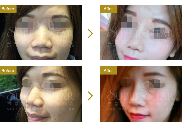 二段式隆鼻 二段式隆鼻