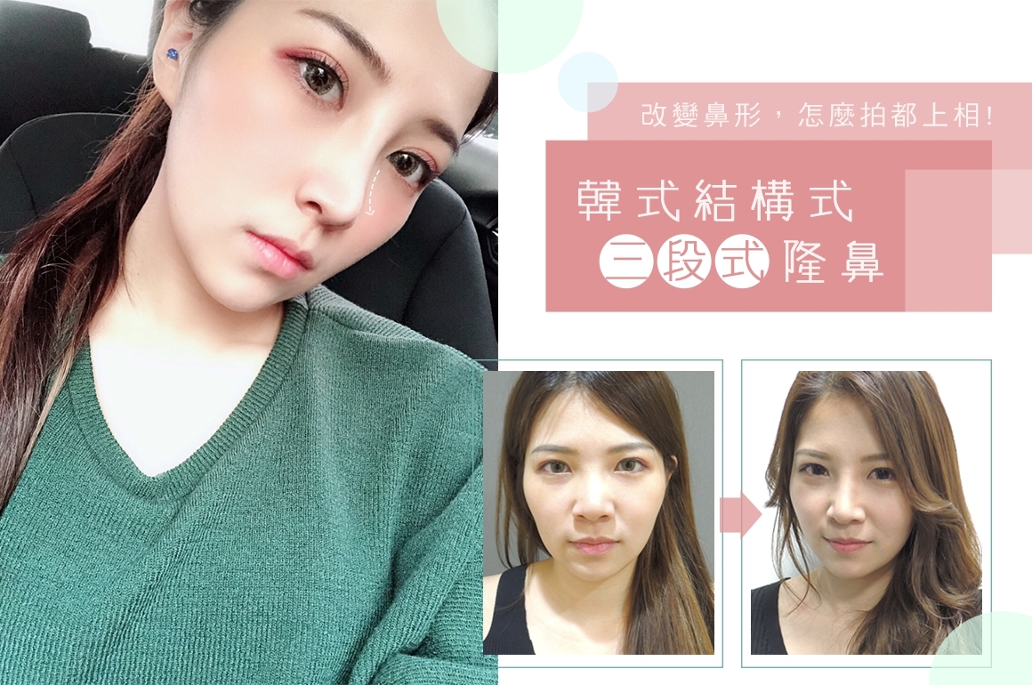 三段式隆鼻, 結構式隆鼻 三段式隆鼻, 結構式隆鼻