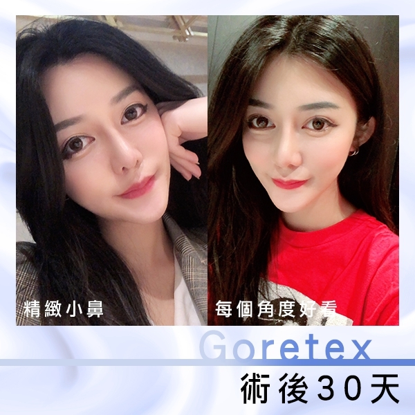 三段式隆鼻, 韓式隆鼻, 結構式隆鼻 三段式隆鼻, 韓式隆鼻, 結構式隆鼻