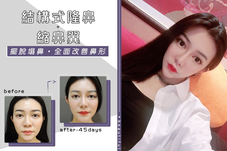 三段式隆鼻, 韓式隆鼻, 結構式隆鼻 三段式隆鼻, 韓式隆鼻, 結構式隆鼻